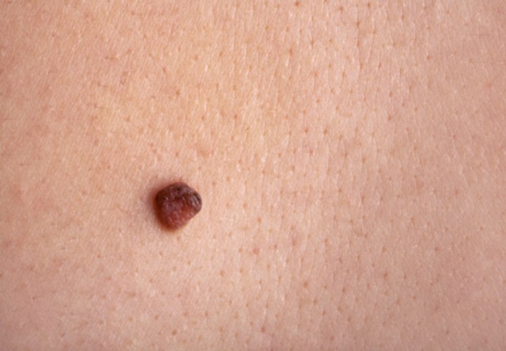 Is it safe to pull off a skin mole?