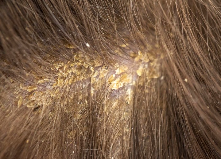 Scalp with flakes
