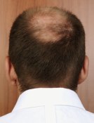 man with a bald spot on the back of his head