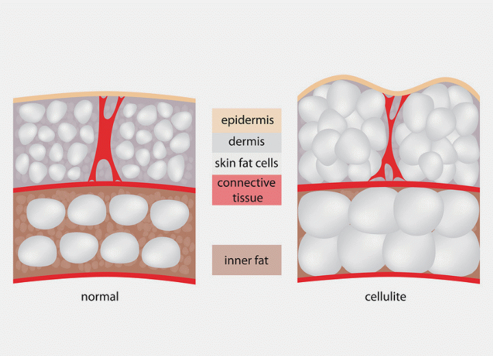 The forming of cellulite
