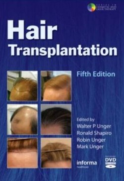 Hair Transplantation