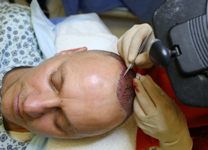 Haartransplantation