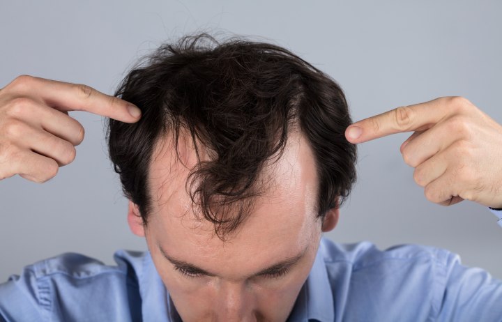 Homme avec perte de cheveux