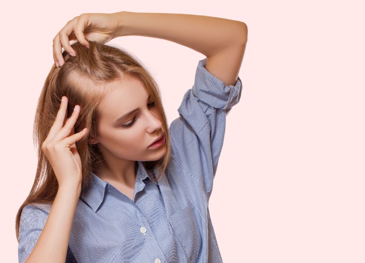 Young woman with alopecia