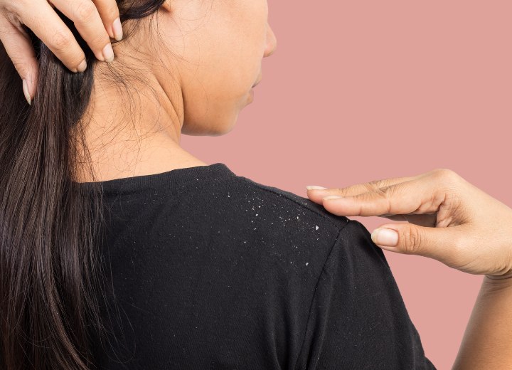 Woman who is suffering from severe dandruff