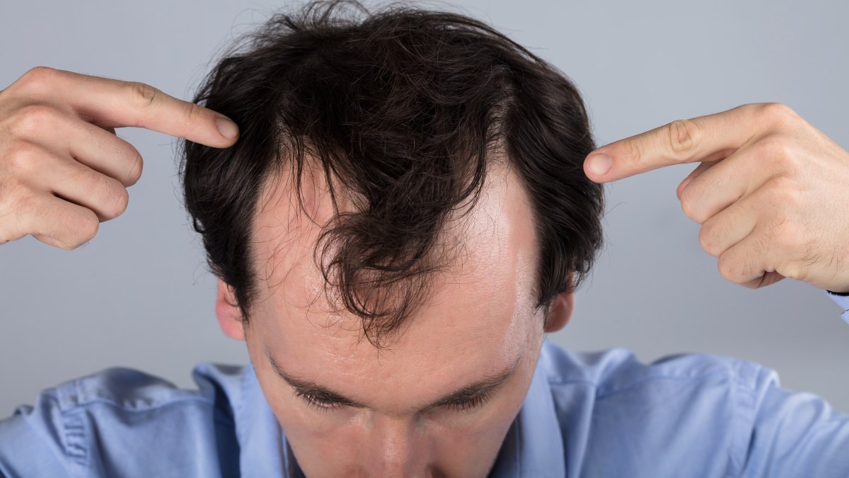 WAYS TO DEAL WITH HAIR LOSS
