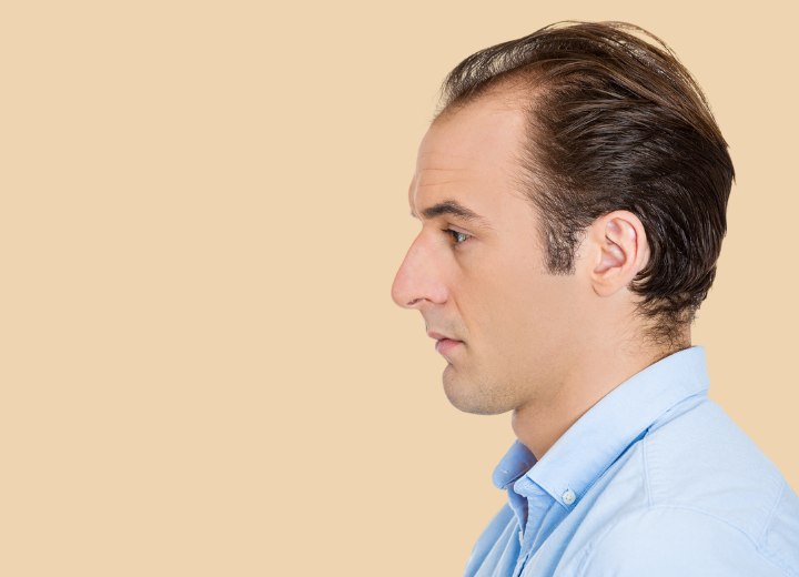 Man with receding hair