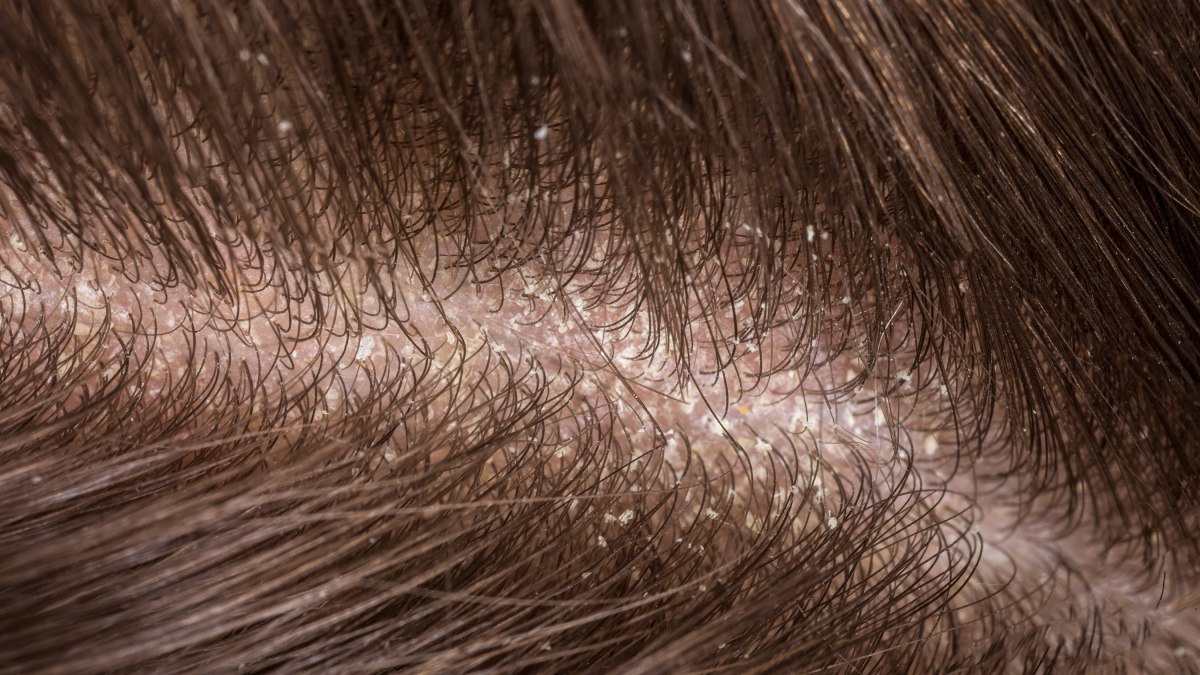 Flakes on the scalp | Scalp peeling off in chunks – Neofollics