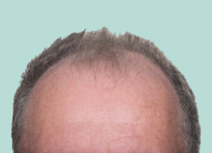 Receding hair line