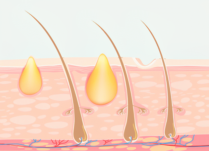 Scalp zits or scalp acne