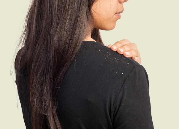 Woman with dandruff