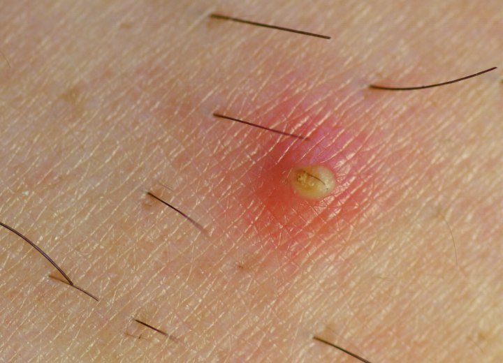 Ingrown hair