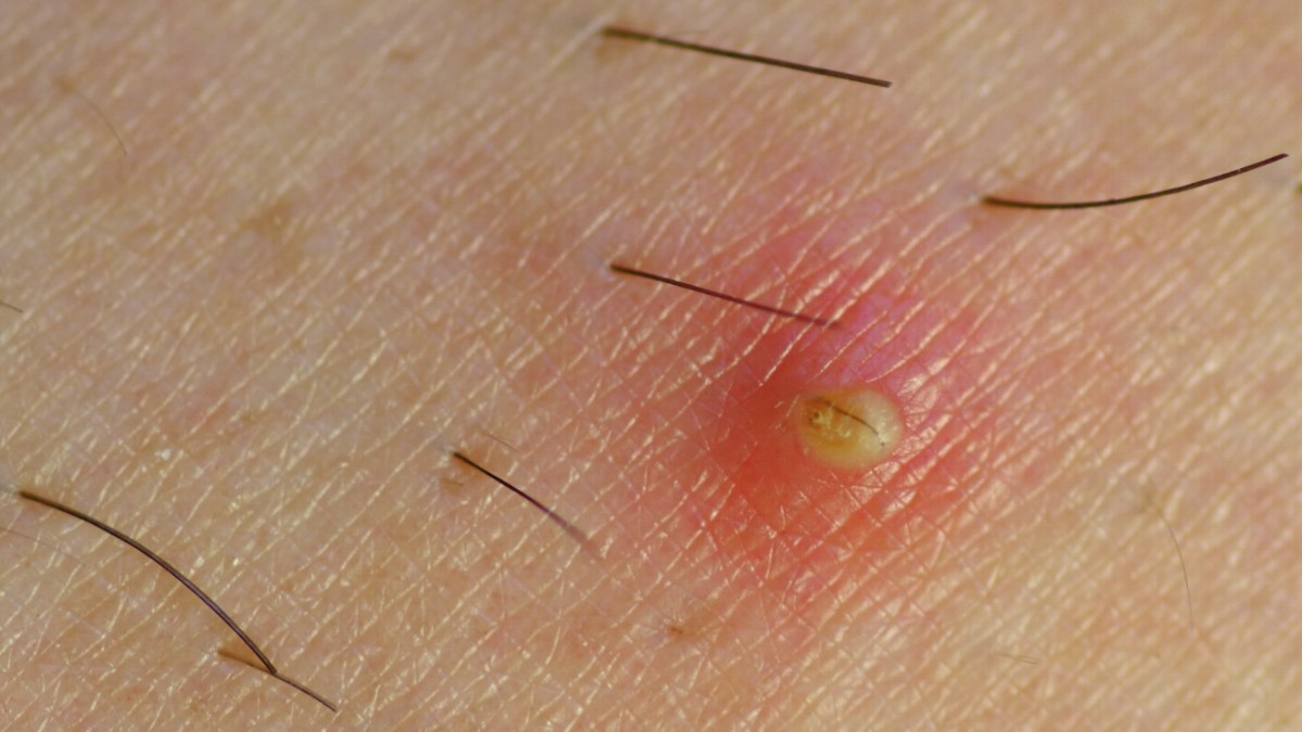 inflamed ingrown hair