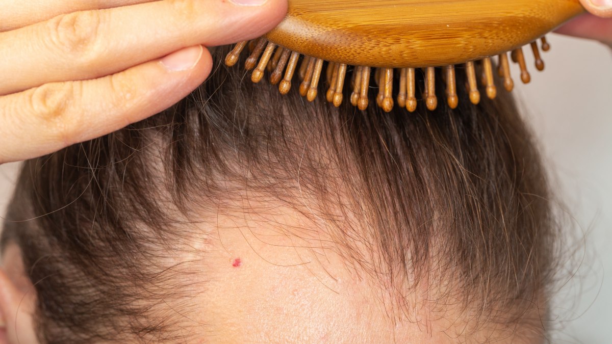 Hair loss and thinning hair, including loss of eyebrows and eyelashes