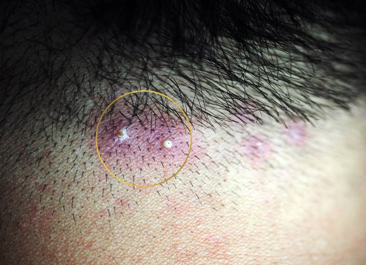 Acne on the scalp