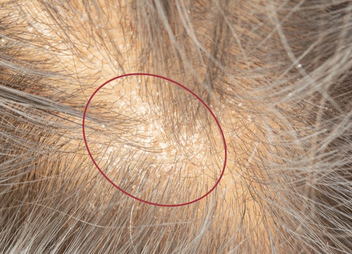 Scalp with dandruff