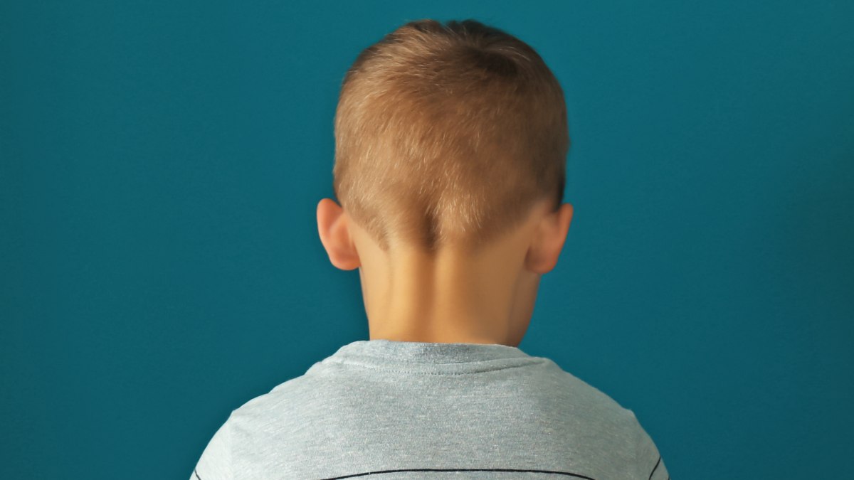 Children's alopecia or childhood alopecia  Hair loss