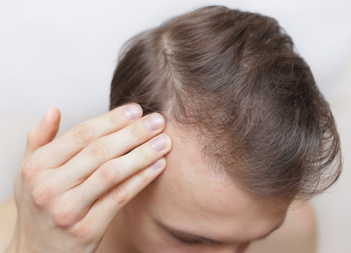 Boy with hair loss