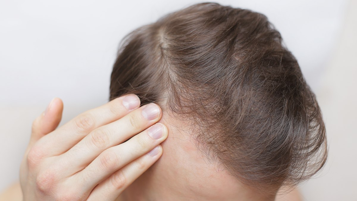 Top 20 effective ways to stop hair fall in men  Dr Batras