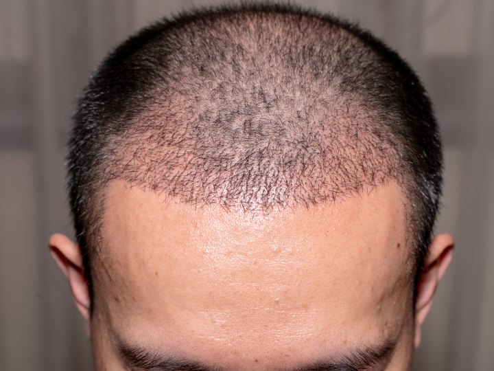 After hair transplant