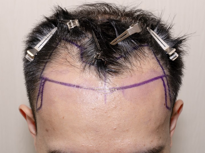 Before hair transplant