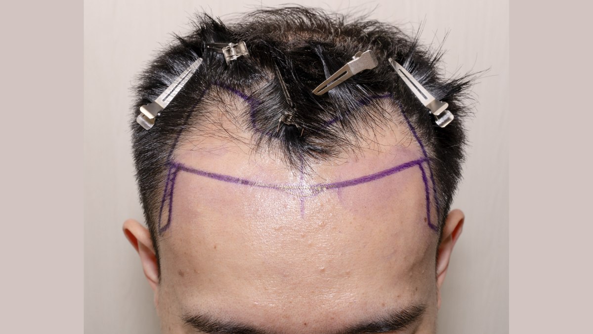 Loss of transplanted hair and hair transplantation procedures with their  success rates