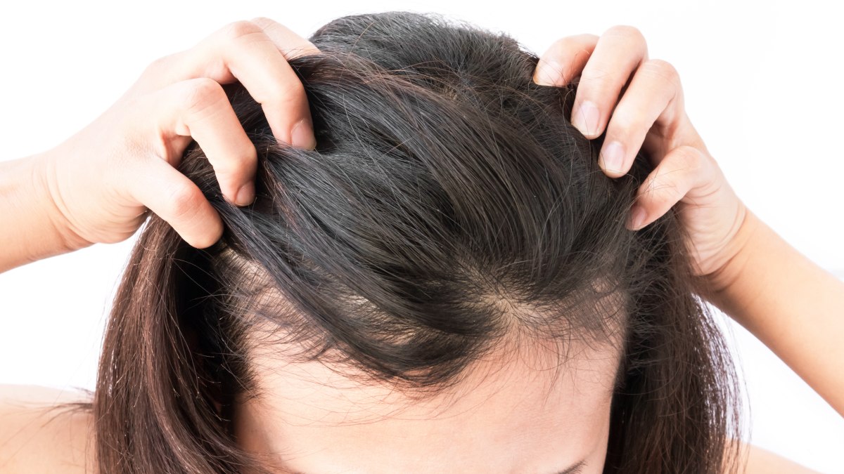 How to Treat Scalp Eczema for Black and Brown Women