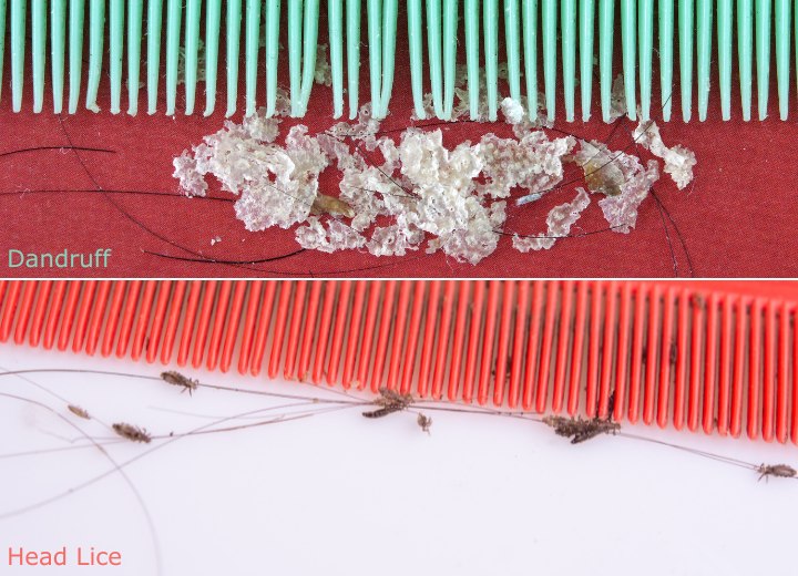 The difference between dandruff and head lice