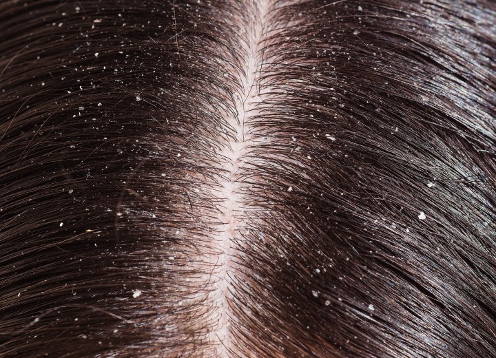 Hair with dandruff