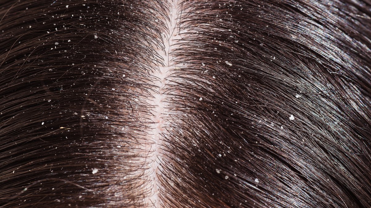 Help for African hair with dandruff problems