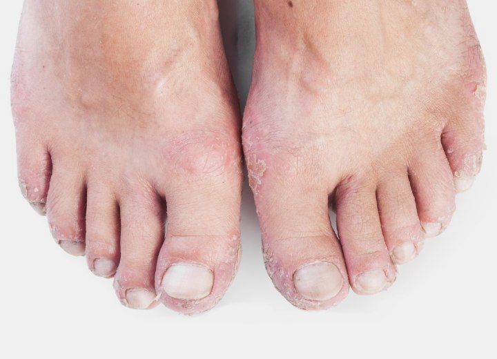Feet with eczema
