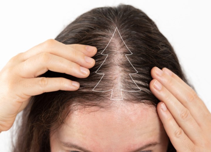 Female hair loss with a Christmas tree pattern