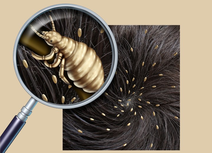 Head lice treatments | Solutions to rid hair of lice and nits