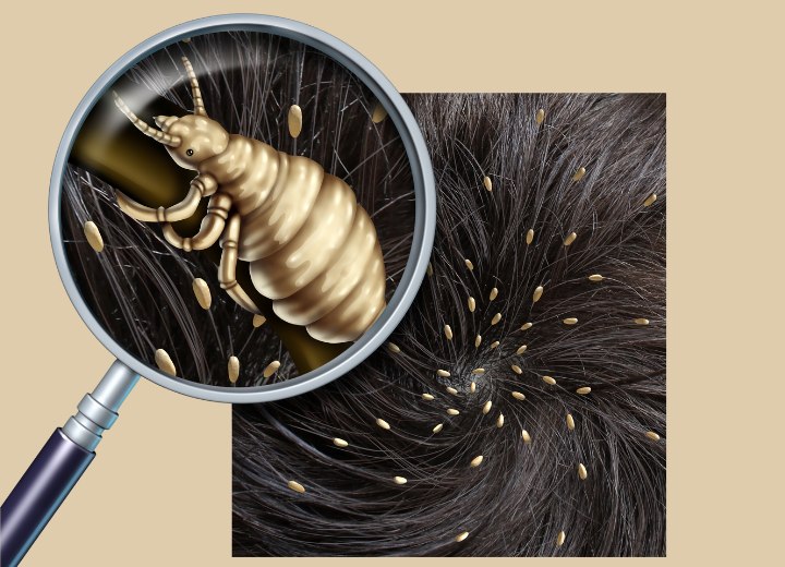 Head lice and nits