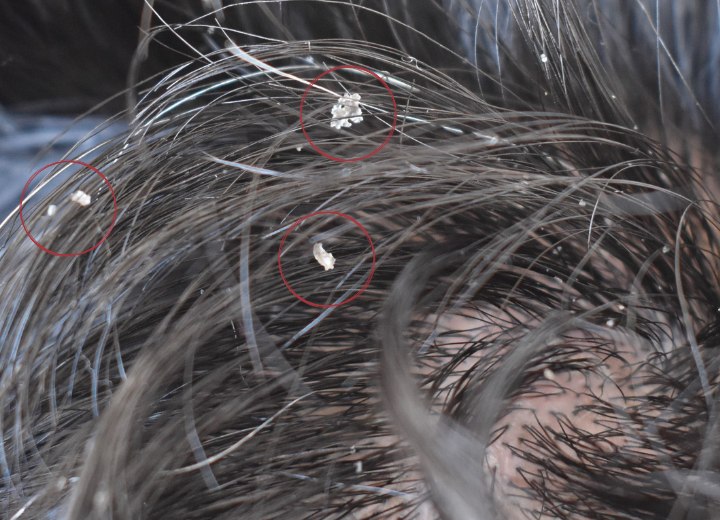Capelli con scaglie di forfora