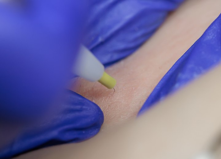 Permanently remove hair with the electrolysis method