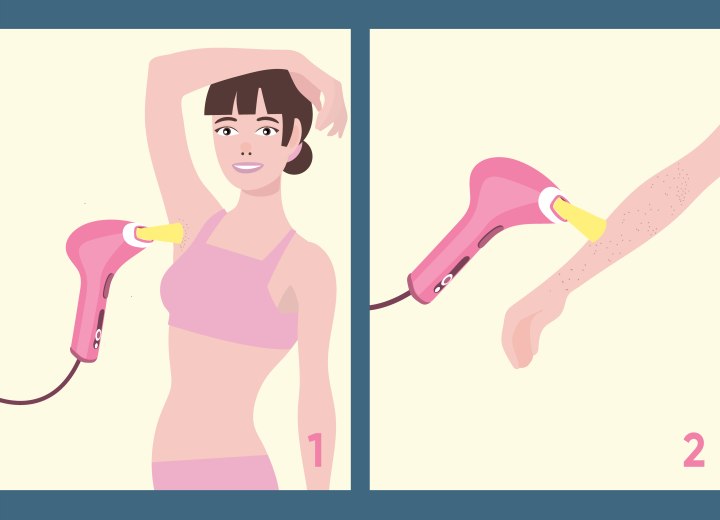 Flashlamp hair removal