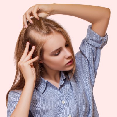 Woman with alopecia