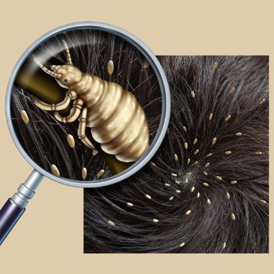 Head lice