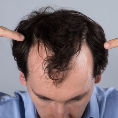 Man with hair loss