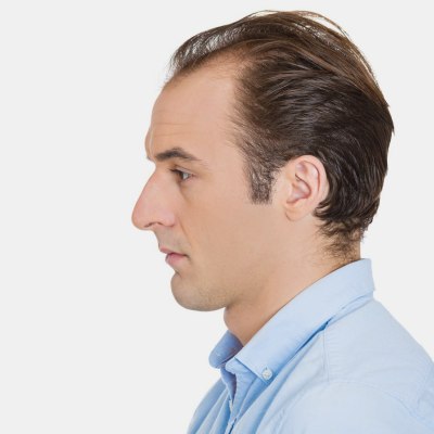 Man with a receding hair line