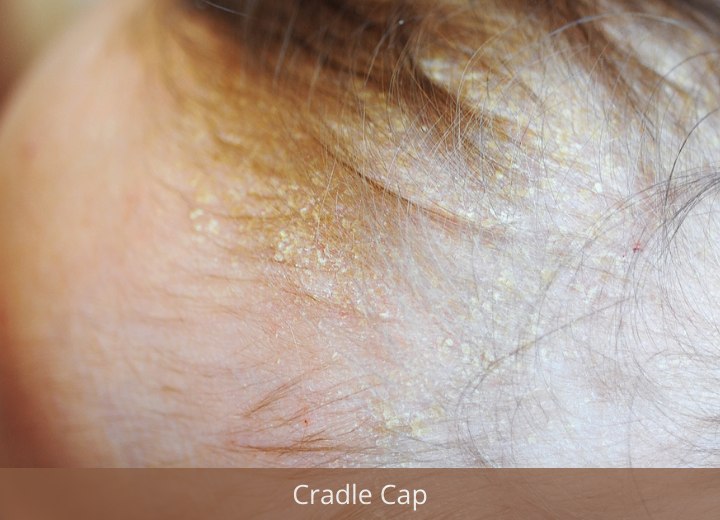 Adult Cradle Cap And A Crusty Scalp Causing Hair Loss And Treating